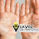 Aíslan a tres niños de kínder en Ciudad Madero por contagio del virus “mano, boca y pie”
