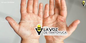 Aíslan a tres niños de kínder en Ciudad Madero por contagio del virus “mano, boca y pie”