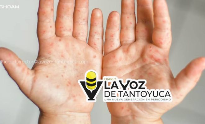 Aíslan a tres niños de kínder en Ciudad Madero por contagio del virus “mano, boca y pie”