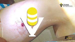 Hombre alcoholizado se dispara accidentalmente en Tantoyuca